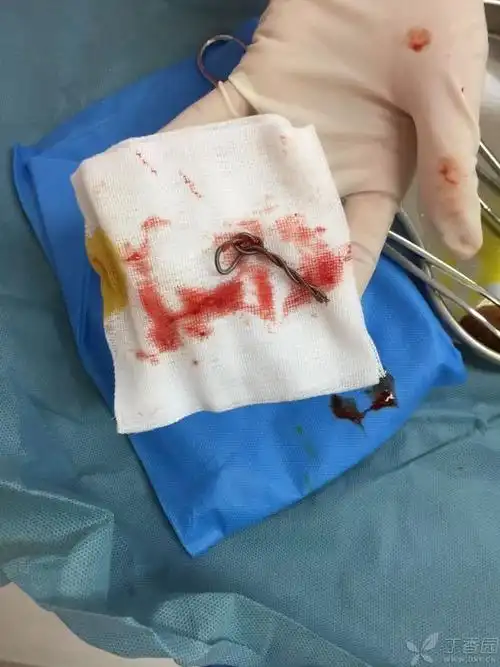 取环钩取出,取环顺利!