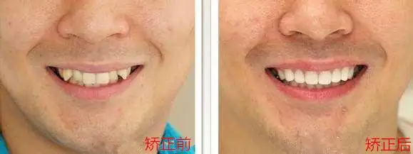 虎牙到底要不要矫正呢看完这篇让你对虎牙彻底改观