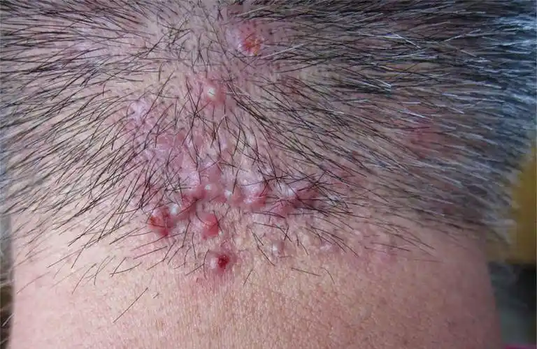 毛囊炎是什么症状图片(项部瘢痕疙瘩性毛囊炎) - 赤虎壹号