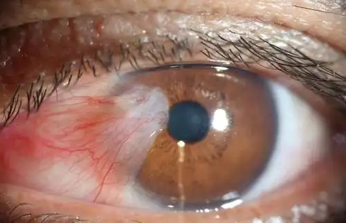 翼状胬肉类型进展型进展型:胬肉的颈部宽大,新生血管多,充血,肥厚,体