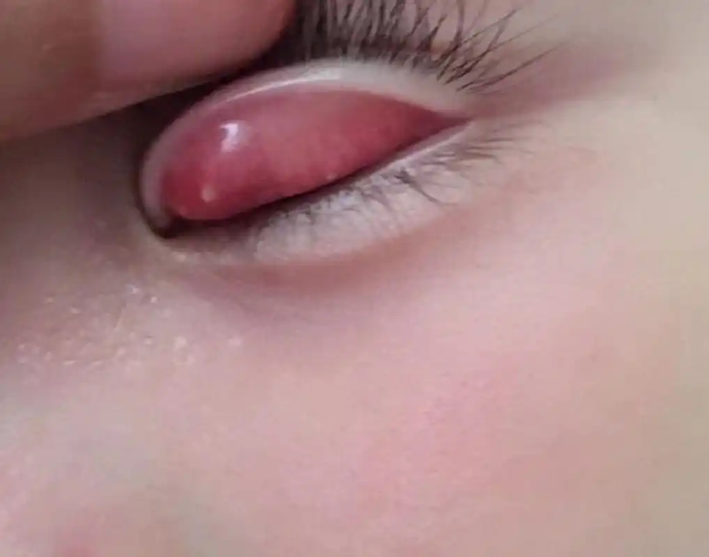 霰粒肿一定要坚持热敷 从图一坚持下来两个月了,终于消的差不多了