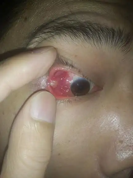 眼睛内角长了个肉疙瘩硬硬的,眼睛还红,多分泌物