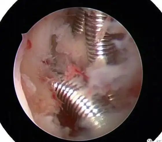 【妇科宫腔镜篇】宫腔镜下取环