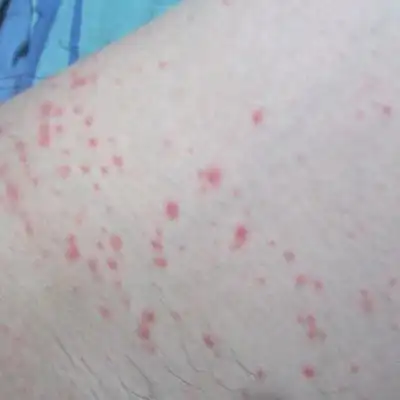 艾滋病大腿上红点图片 (6)