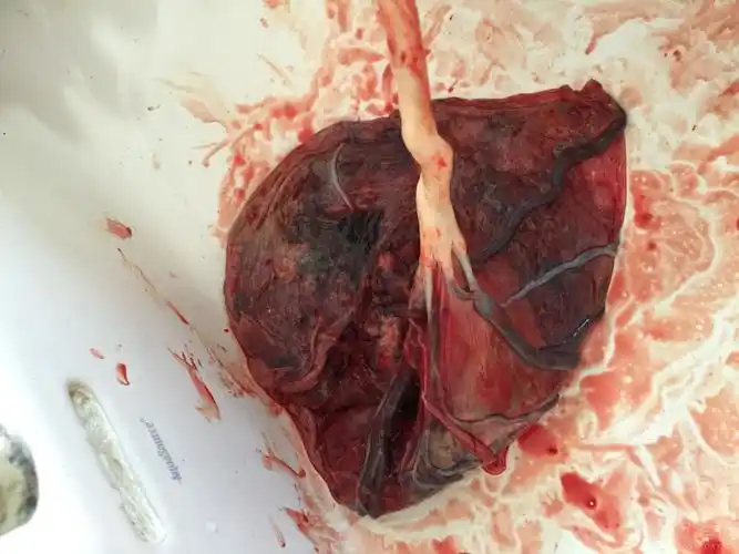 这应该是膜状胎盘吧