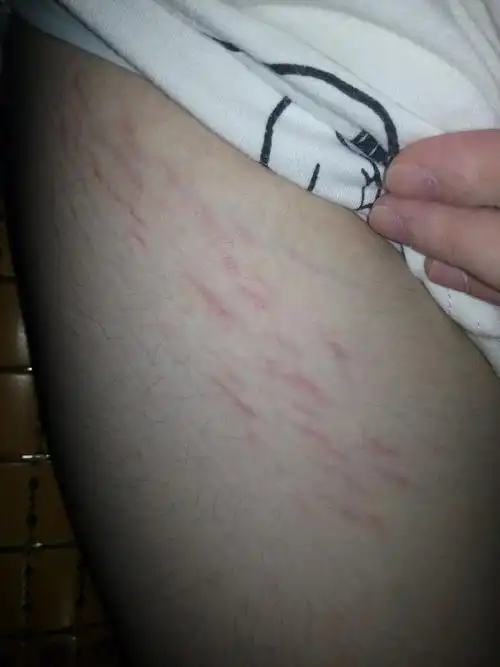 问:大腿的两侧有这种红红的斑,请问这是什么?