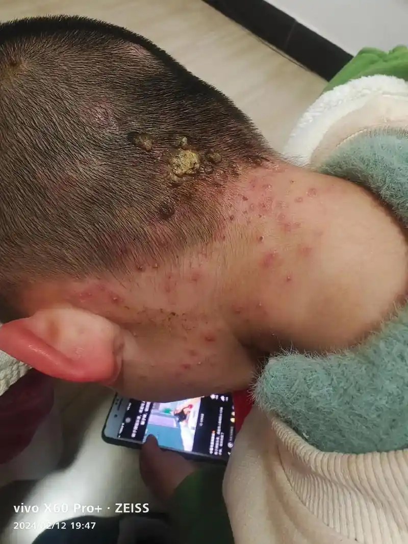 五岁多,毛囊炎,淋巴结肿大,四个月前开始出现,两个月前就开始 - 抖音