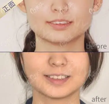 我在厦门麦芽口腔戴隐适美牙套前后脸型变化图