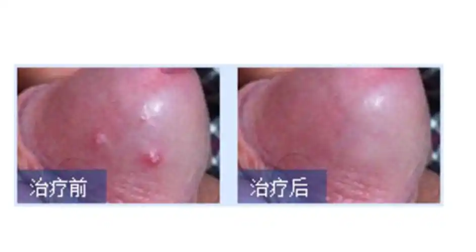 生殖器疱疹治疗