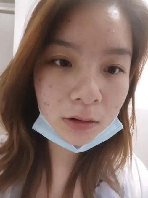 有没有长得好看但长痘痘的女生? - 知乎