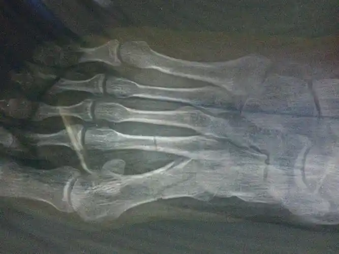 脚掌大拇指和二拇指骨折,多长时间能好,有后遗症吗?