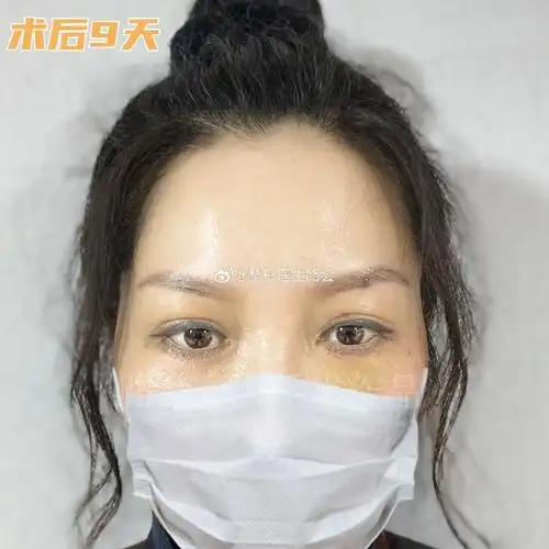 求美者反馈##眼袋泪沟##眼周年轻化##用手术照讲个故事##脂肪泪沟