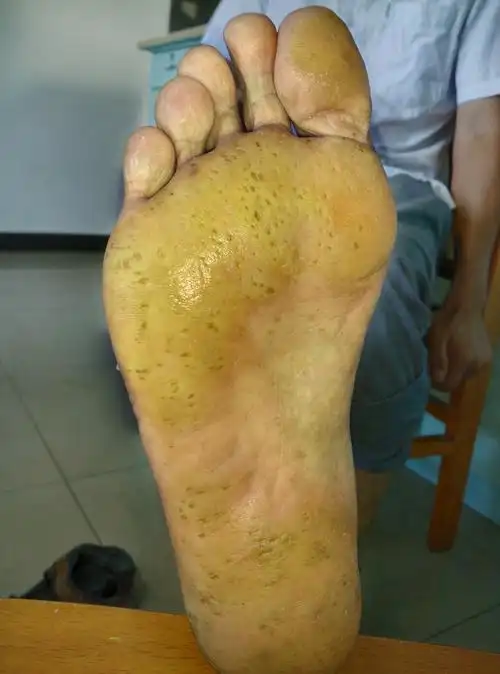 反复发作持续生长的双足底皮肤大面积角质化
