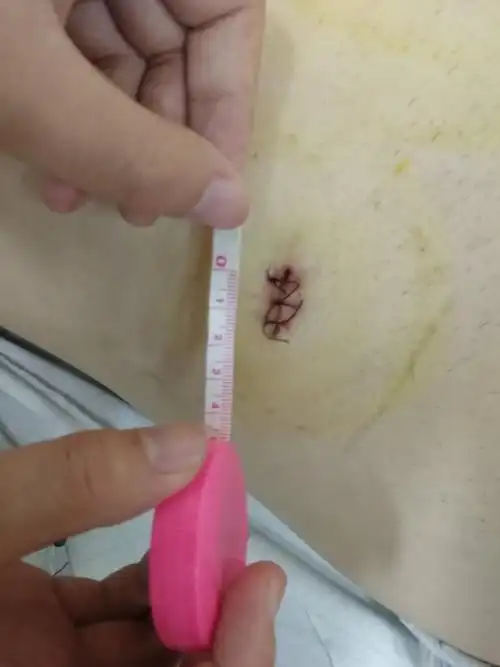 写美篇外科治疗mg的传统手术入路是胸骨正中切口开胸,优点是直视操作