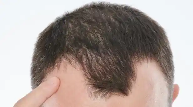 脑门有褶怎么办