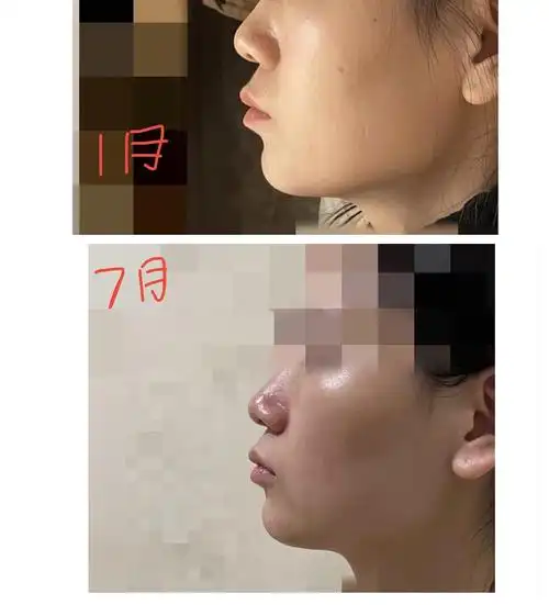 23岁第二次戴牙套 深覆合 牙性骨性 鼻基底凹陷