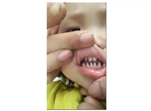 网红小男孩鲨鱼转世满嘴尖牙,网友调侃,可以本色出演鬼鲛了