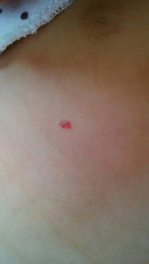 问:婴儿胸前有一个红点,像血泡,手摸上去有一点凸出