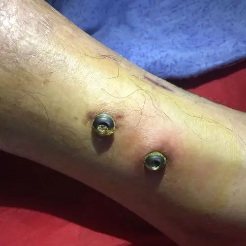 骨折手术后内固定钉完全露在皮表面(看图片),刚拆线时就发现了钉帽在