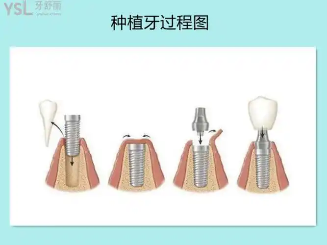 今日曝料:韩国种植牙品牌哪种好及韩国种植牙多少钱一颗