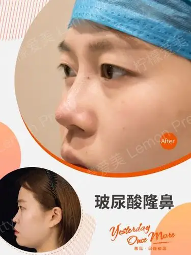 【变美小课堂】玻尿酸又能保湿又能垫鼻子?