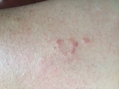 大腿内侧长仔仔,很痒,不知道是湿疹还是癣?