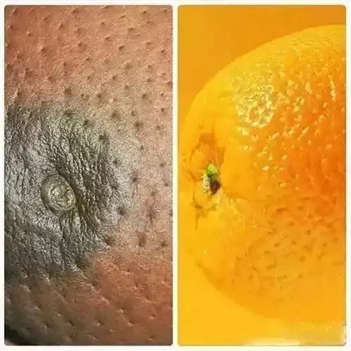 胸部出现"小酒窝",当心是乳腺肿瘤!_乳房