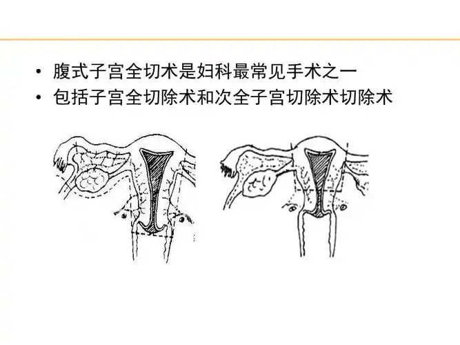 腹式子宫全切术.ppt_第4页