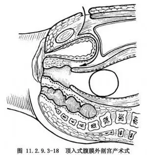 腹膜外剖宫产术