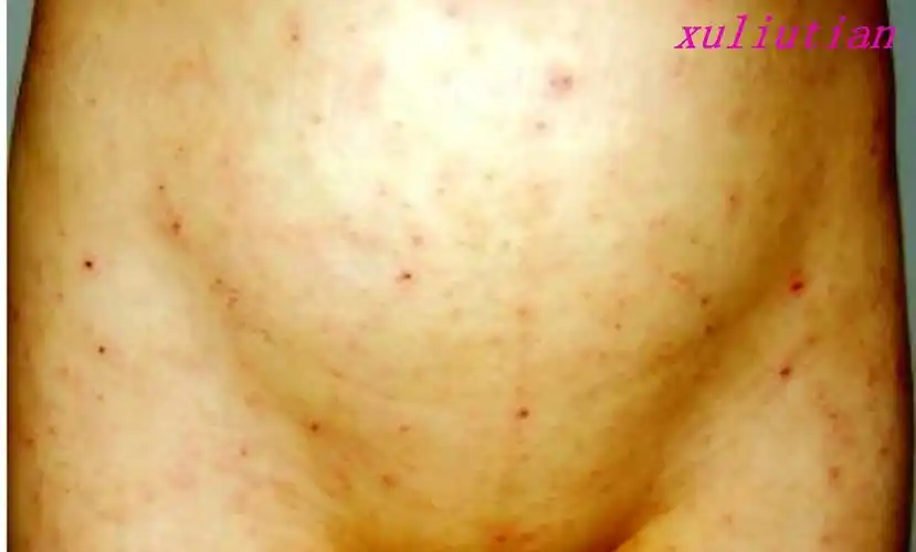 痒死人的疥疮,如何防止治疗失败?