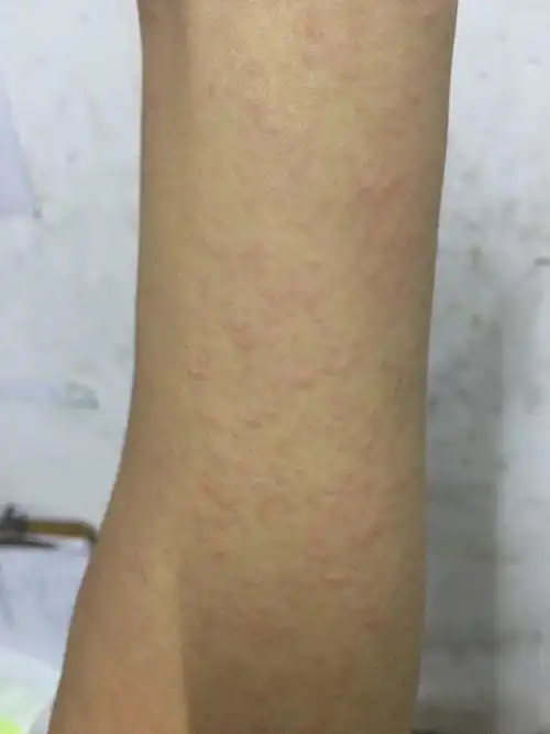 一热身上就起疙瘩,有点痒.一片一片的 特别是胳膊上 今年开始的