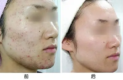 治疗痤疮印前后对比图