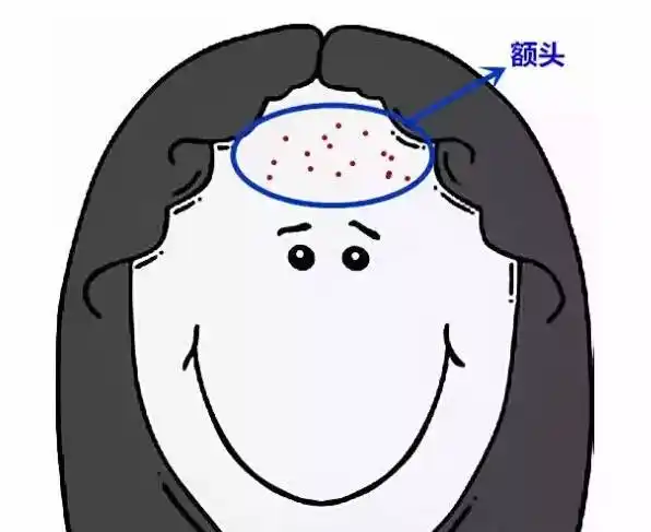 额头长痘痘什么原因六种原因你了解吗
