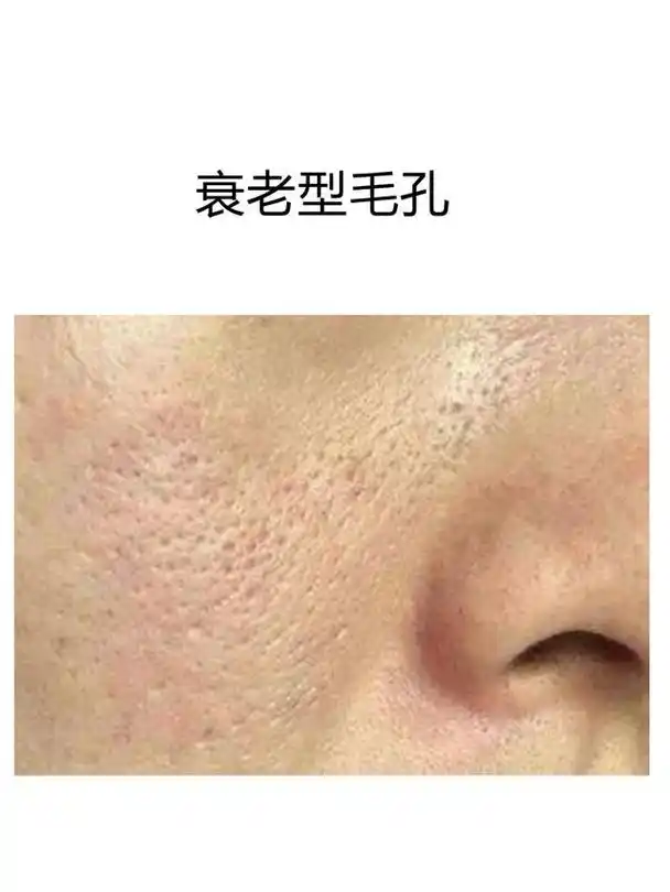 正确判断你的毛孔是哪种类型,才能对症下药!
