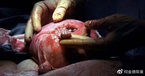 当年这位21周大的胎儿「伸出手握住医生的照片」震撼全球!