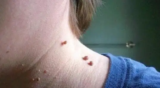 土方治扁平疣(你会用奶奶教你的小偏方治疗扁平疣吗?