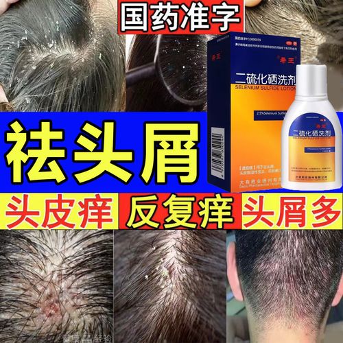 二硫化硒洗剂洗发水祛屑止痒去屑医用国药准字头皮痒脂溢性皮炎头皮