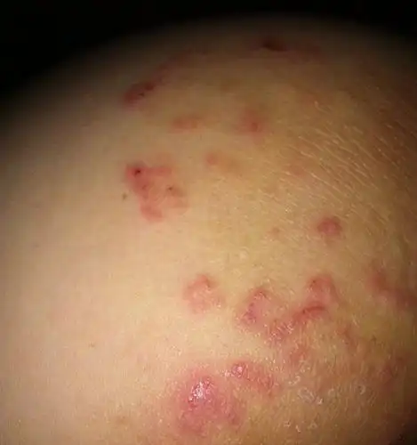 腿上长和屁股上长疖子,屁股上还长了像癣一样的,又痒,抓了掉皮.