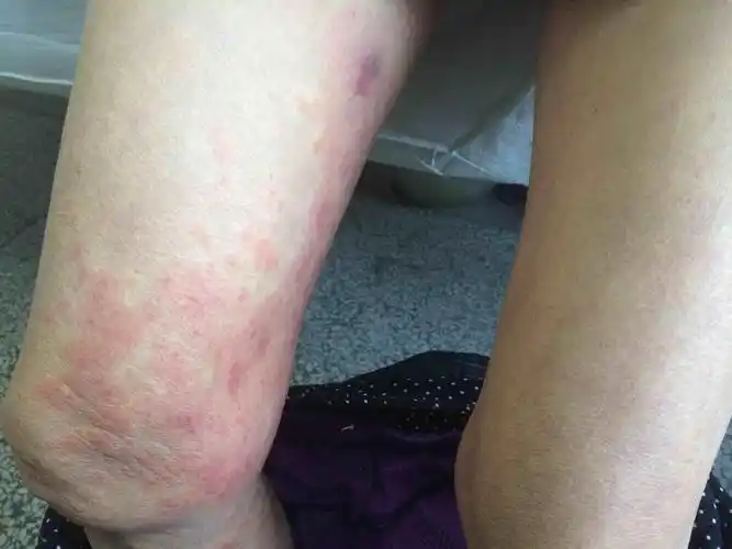 右下肢皮肤红斑伴瘙痒不适3天
