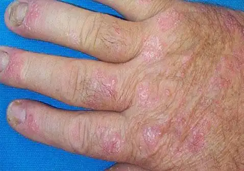 银屑病关节炎是什么病啊