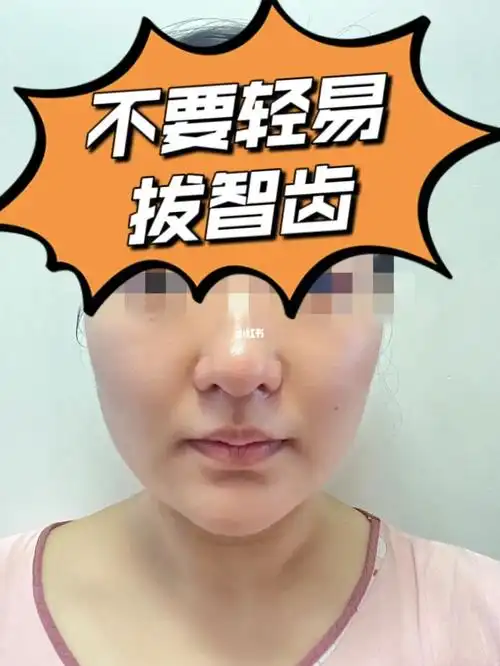 拔智齿当天脸就凹进去了,会垂吗01