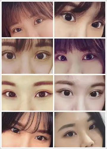 埋线(五点式)双眼皮分享