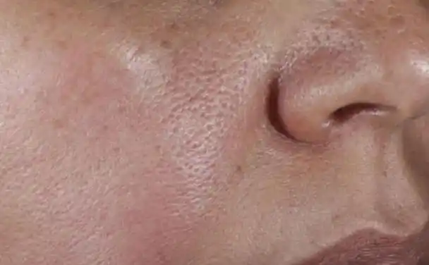 毛孔粗大怎么办什么方法最好(毛孔粗大怎么办)1