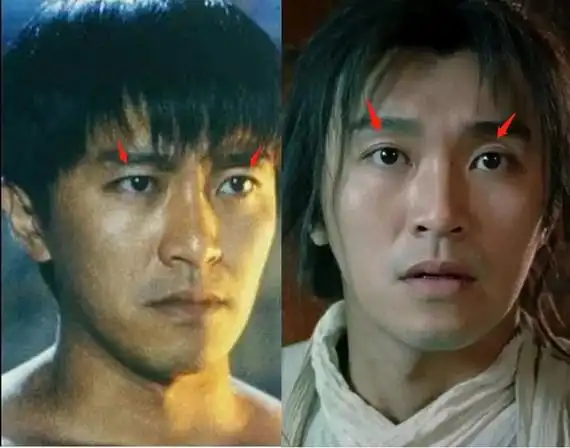 羊仔细翻图对比确认应该是手术的,不止是脂肪流失导致的双眼皮皱褶变