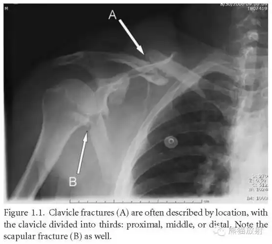 【急诊必读】肩关节平片--临床影像示例(附9例)