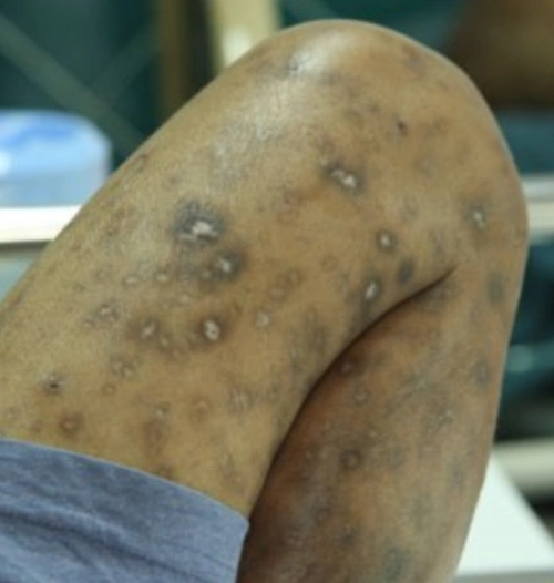 艾滋病舌部图片