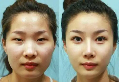 实拍:韩国女子整容前后的对比图,让人不敢相信自己的眼睛!
