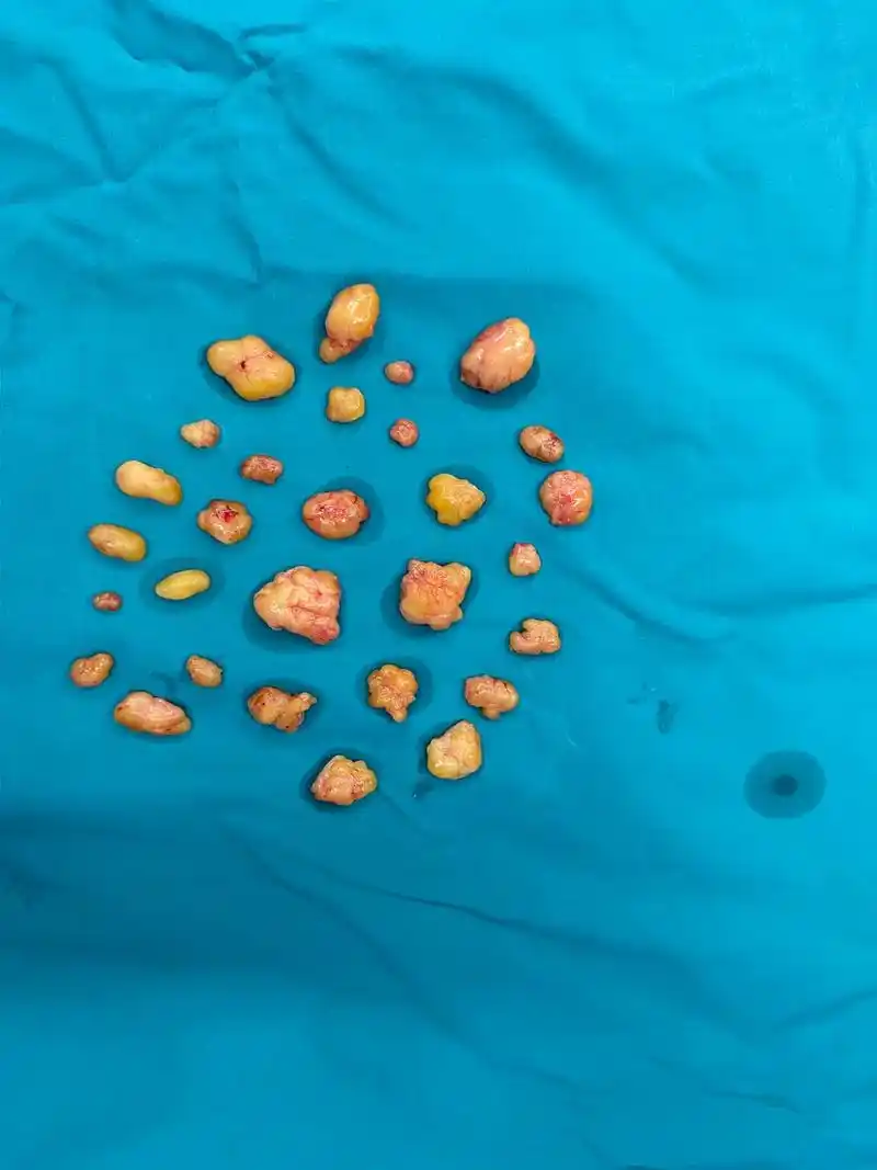 双大腿多发性皮下脂肪瘤1例#手术室你不知道的事 #今日分享 - 抖音