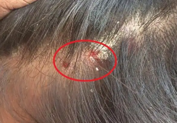 的话,就会阻碍头皮毛孔的呼吸和排泄的分泌,这样就会导致头皮出现痤疮