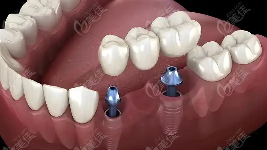 种植牙示意图